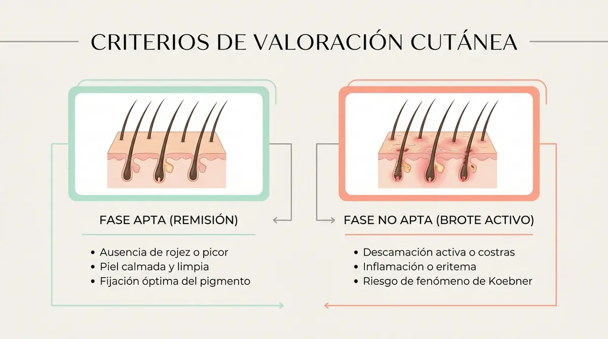 Infografía de criterios de valoración de la piel para micropigmentación capilar con dermatitis seborreica
